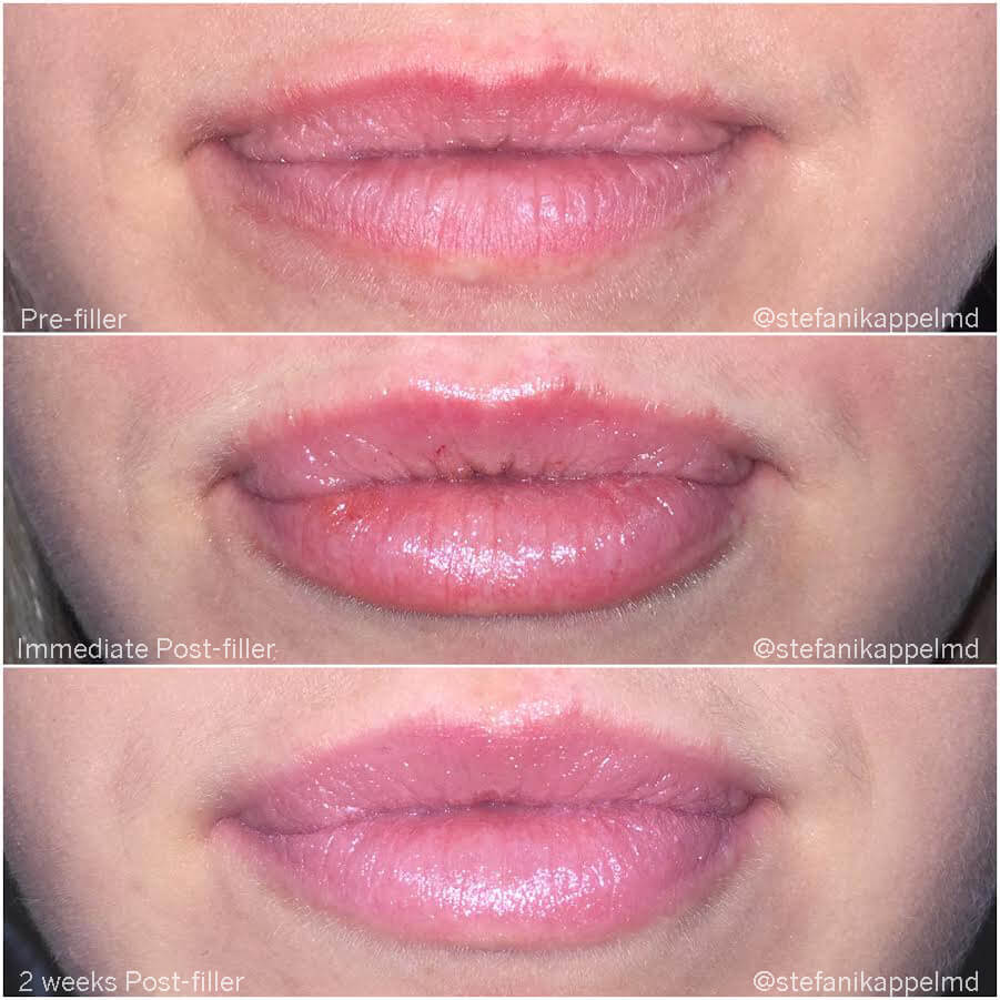 Before and After Lip Injection